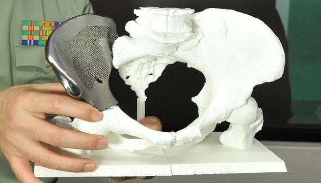 3D列印醫療加入 脊椎側彎手術定位增準 | 文章內置圖片