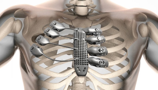 3D列印醫療加入 脊椎側彎手術定位增準