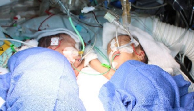 瑞士醫療首例 成功分離出生八天連體嬰 | 文章內置圖片