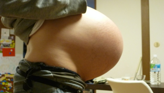 孕婦羊水過多症有一半的機率會導致早產、流產