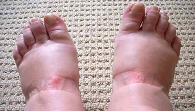小心！腳底水腫脹痛無法行走，栓塞嚴重會致死！