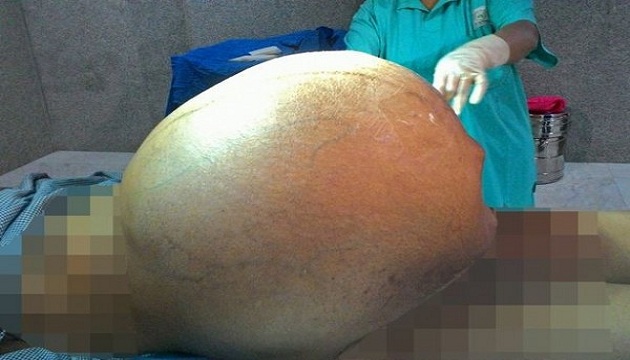 歐買尬！印度婦人竟能忍痛5年養出97公斤巨瘤