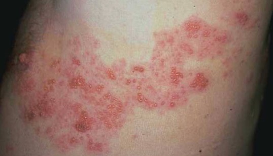 梅雨季皮肤长水痘 小心「皮蛇」病毒缠上你！