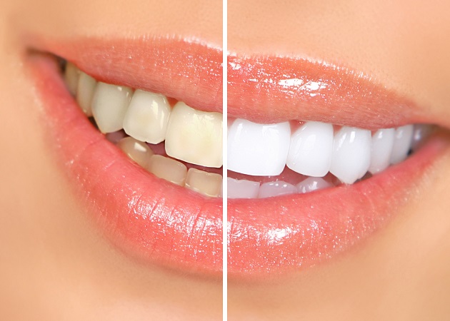 如何改善滿口黃牙？ 第一步：改變飲食 還你亮白牙齒