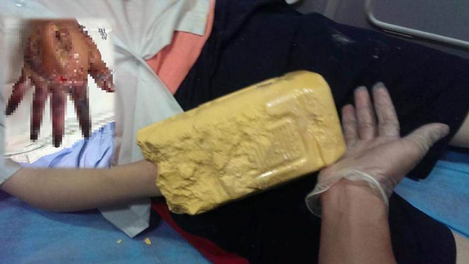 17歲女幫媽媽做手模行善 手部灼燒恐截肢 | 文章內置圖片