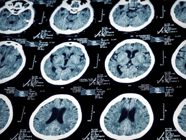 阿茲海默症有機會根治？  英研究：經痛藥能抑制腦部發炎 | 文章內置圖片