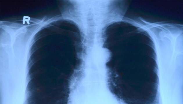 她久咳未癒看醫生 肺部竟見兩顆腫瘤 | 文章內置圖片