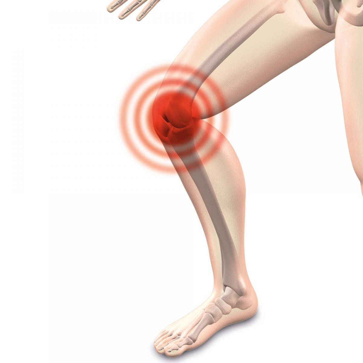 退化性關節炎改善撇步:飲食、護膝、復健 | 文章內置圖片
