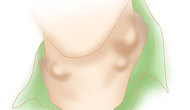 脖子有腫塊 可能是鼻咽癌警訊 | 文章內置圖片